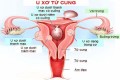 Mổ u xơ tử cung ở đâu tốt