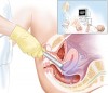 Cách điều trị viêm âm đạo hiệu quả