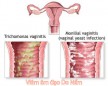Viêm Nấm Âm Đạo: Nguyên nhân và Biểu hiện