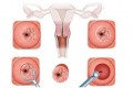 Viêm cổ tử cung và 7 cách chữa hiệu quả
