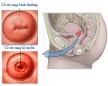 Viêm lộ tuyến cổ tử cung