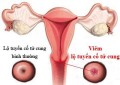 Chi phí đốt viêm lộ tuyến cổ tử cung hết bao nhiêu tiền