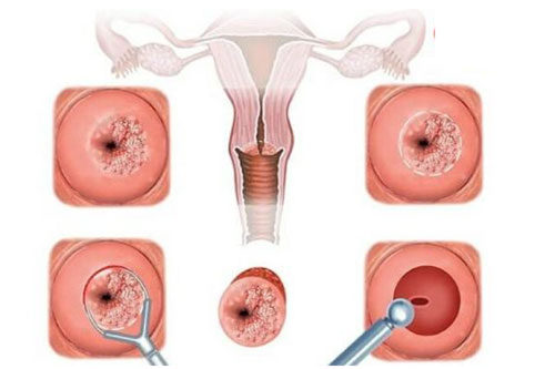 Viêm cổ tử cung và 7 cách chữa hiệu quả