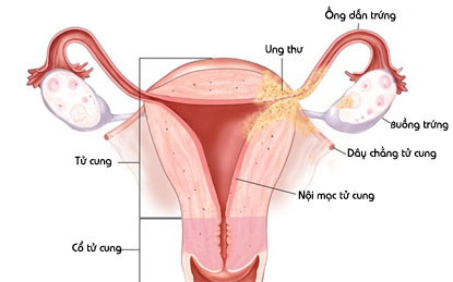 viêm cổ tử cung