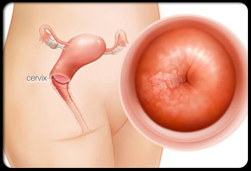 Viêm cổ tử cung là gì?