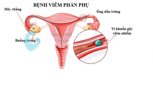Viêm phần phụ