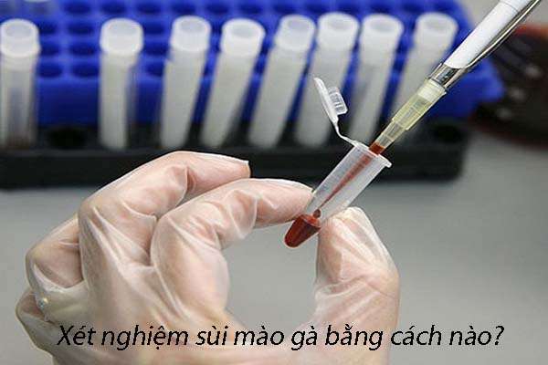 xét nghiệm sùi mào gà bằng cách nào